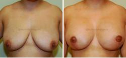 Breast Lift result at Sugar Land Plastic Surgery in Sugar Land, TX