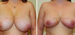 Sugar Land Plastic Surgery breast reduction result — Sugar Land, TX