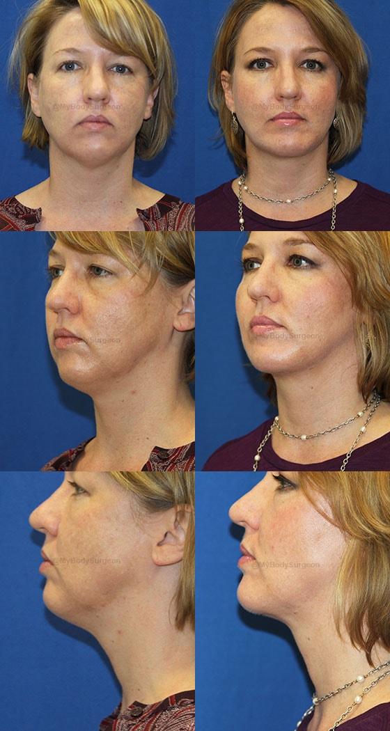 Chin Implant result at Sugar Land Plastic Surgery in Sugar Land, TX