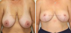 Sugar Land Plastic Surgery breast reduction result — Sugar Land, TX