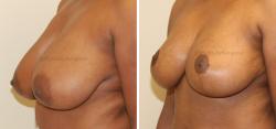 Sugar Land Plastic Surgery breast reduction result — Sugar Land, TX