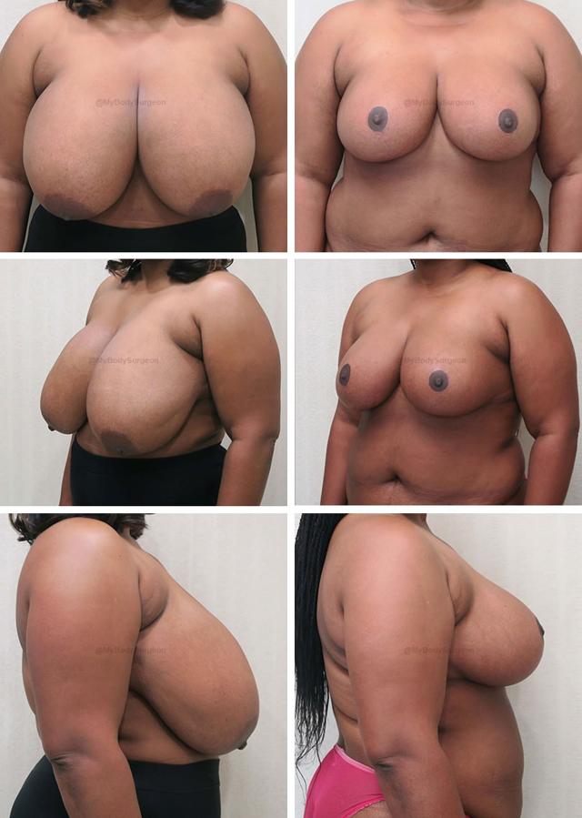 Breast Reduction result at Sugar Land Plastic Surgery in Sugar Land, TX