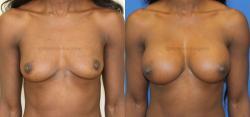 Breast Augmentation result at Sugar Land Plastic Surgery in Sugar Land, TX