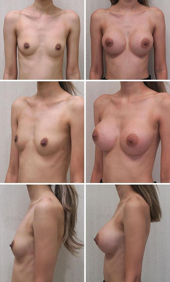 Breast Augmentation result at Sugar Land Plastic Surgery in Sugar Land, TX