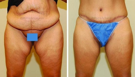 Thigh Lift result at Sugar Land Plastic Surgery in Sugar Land, TX
