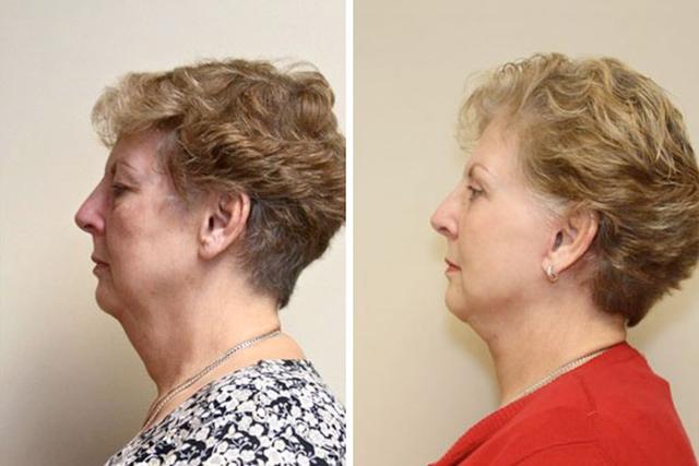 Deep Plane Facelift result at Sugar Land Plastic Surgery in Sugar Land, TX