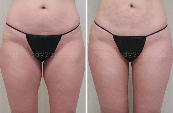 Liposuction result at Sugar Land Plastic Surgery in Sugar Land, TX
