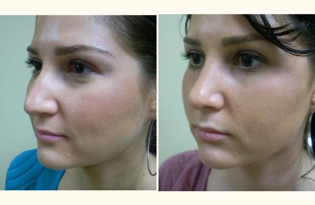 Functional Rhinoplasty result at Andrew P. Amunategui, MD in Aventura, FL