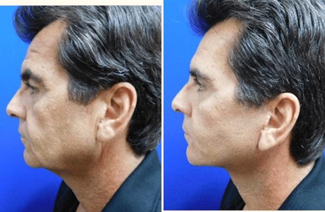 Deep Plane Facelift result at Andrew P. Amunategui, MD in Aventura, FL
