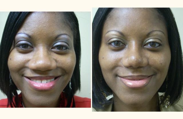 Functional Rhinoplasty result at Andrew P. Amunategui, MD in Aventura, FL