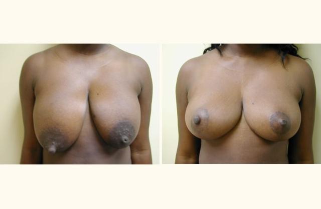 Breast Reduction result at Andrew P. Amunategui, MD in Aventura, FL