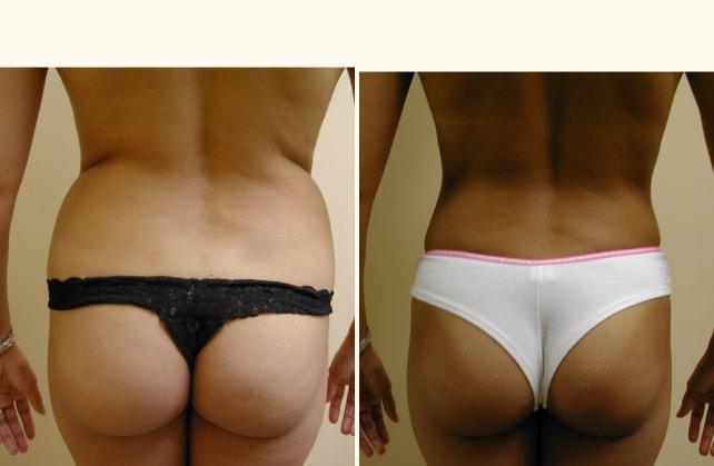 Andrew P. Amunategui, MD liposuction result — Aventura, FL
