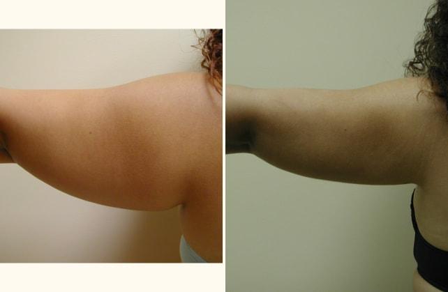 Andrew P. Amunategui, MD liposuction result — Aventura, FL
