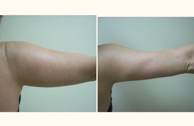 Andrew P. Amunategui, MD liposuction result — Aventura, FL