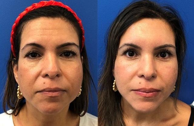 Brow Lift result at Andrew P. Amunategui, MD in Aventura, FL