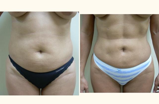 Andrew P. Amunategui, MD liposuction result — Aventura, FL