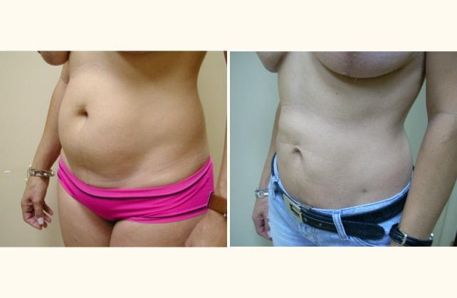 Andrew P. Amunategui, MD liposuction result — Aventura, FL