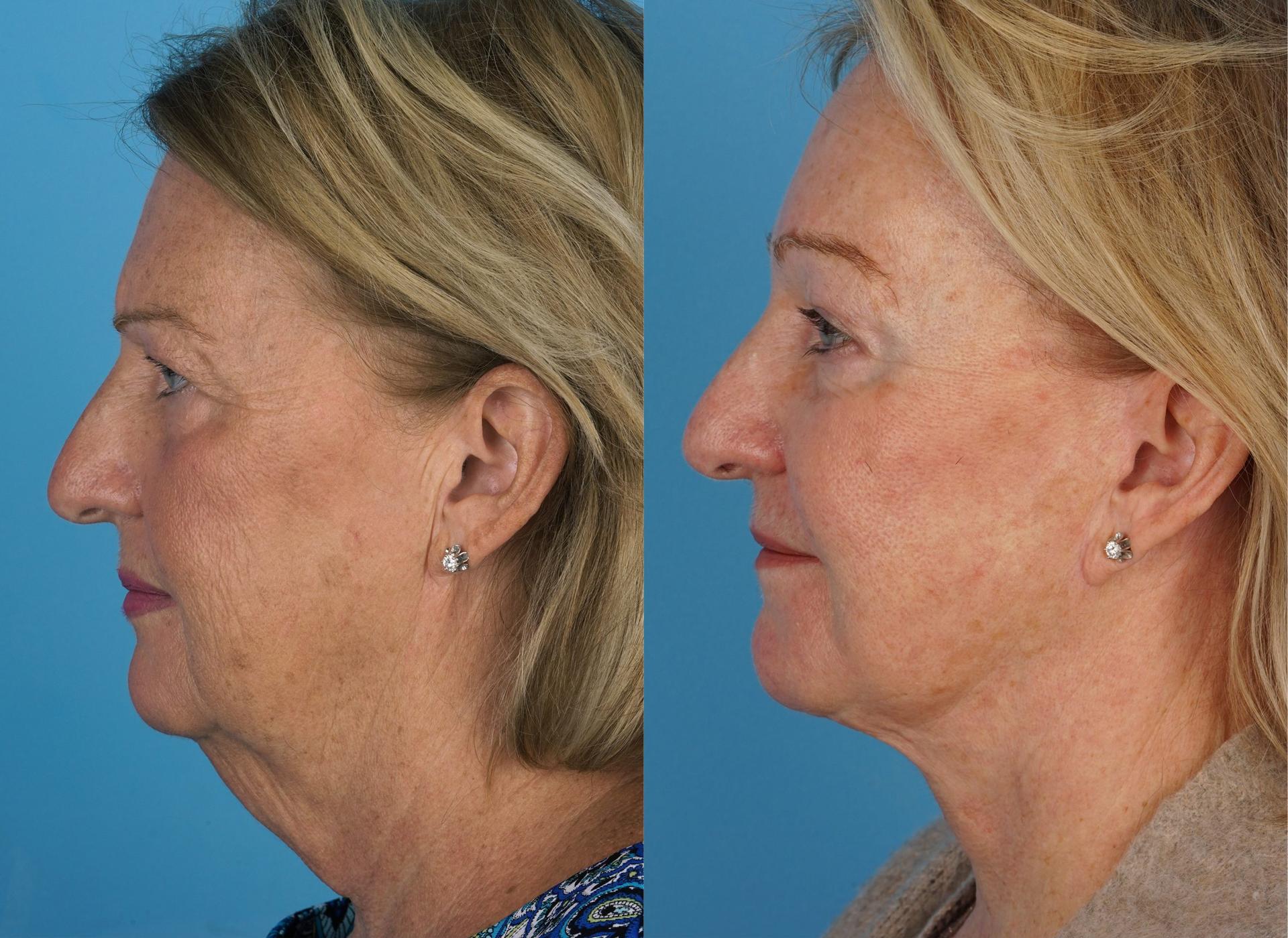 Jefferson Facial Plastics facelift result — Philadelphia, PA