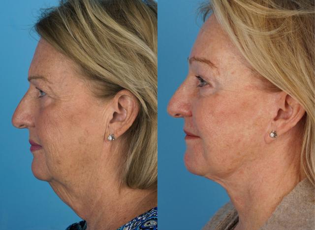 Facelift result at Jefferson Facial Plastics in Philadelphia, PA