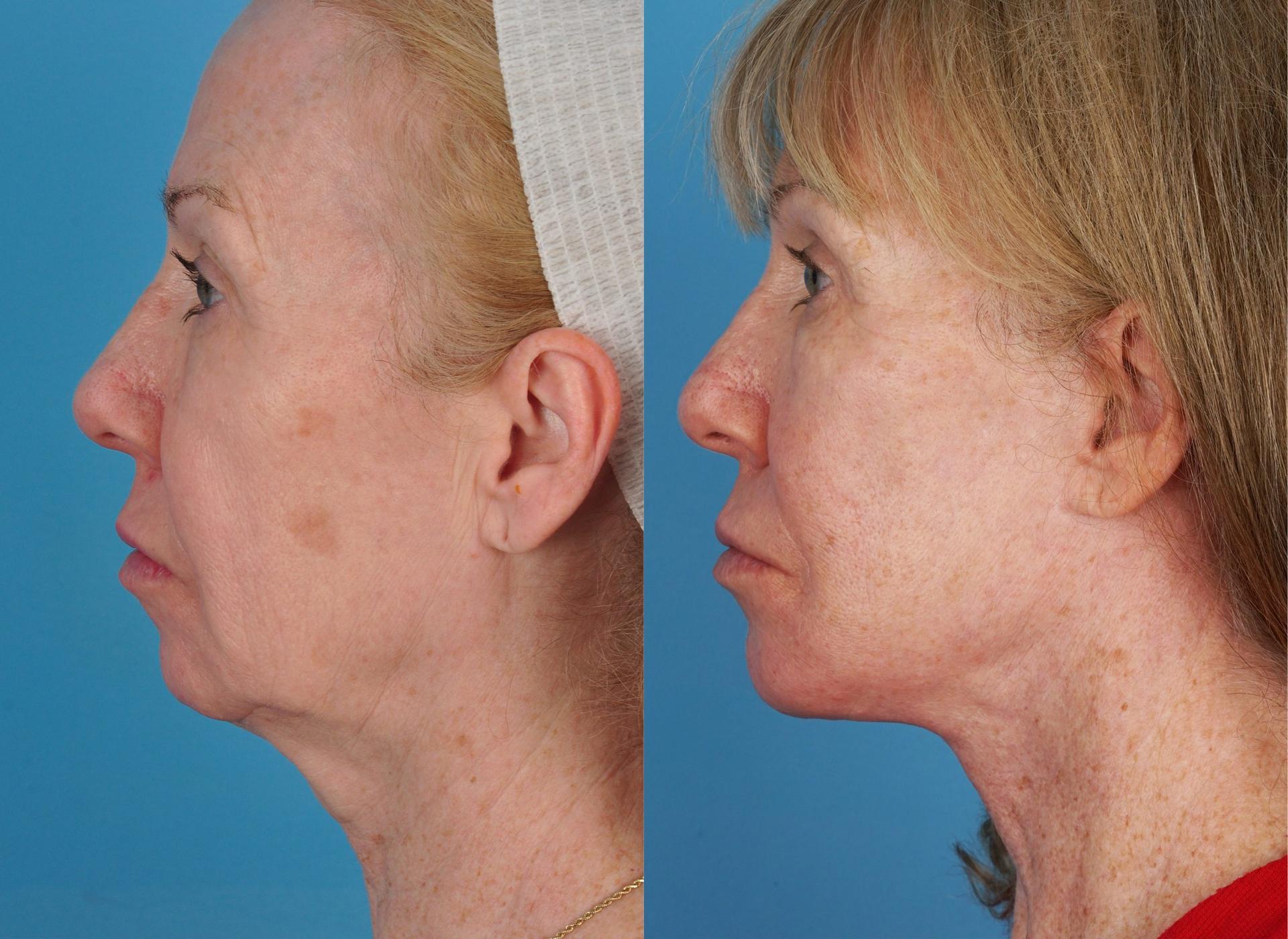 Jefferson Facial Plastics facelift result — Philadelphia, PA