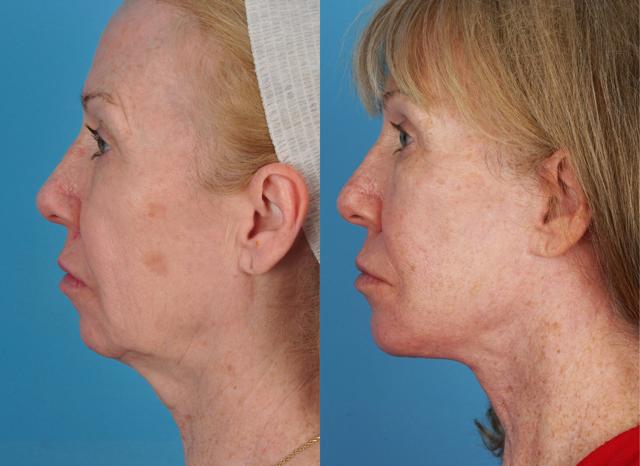 Facelift result at Jefferson Facial Plastics in Philadelphia, PA