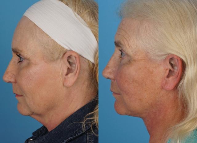 Facelift result at Jefferson Facial Plastics in Philadelphia, PA