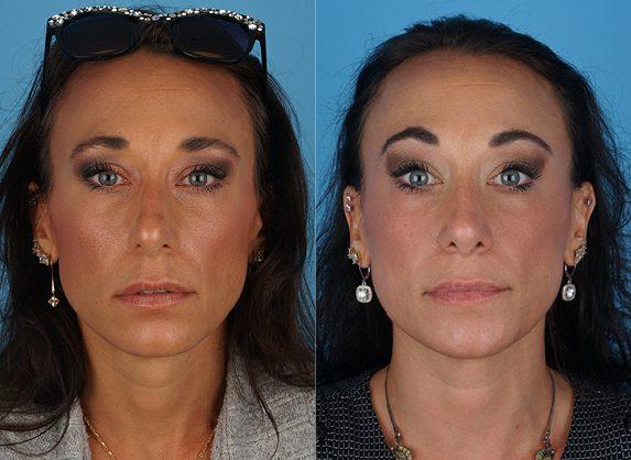 Rhinoplasty result at Jefferson Facial Plastics in Philadelphia, PA