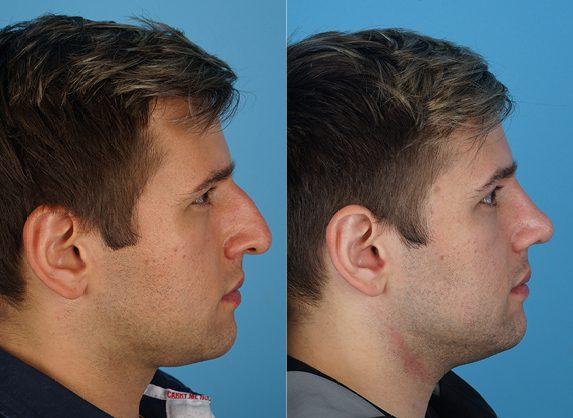 Rhinoplasty result at Jefferson Facial Plastics in Philadelphia, PA