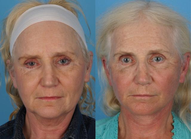 Facelift result at Jefferson Facial Plastics in Philadelphia, PA