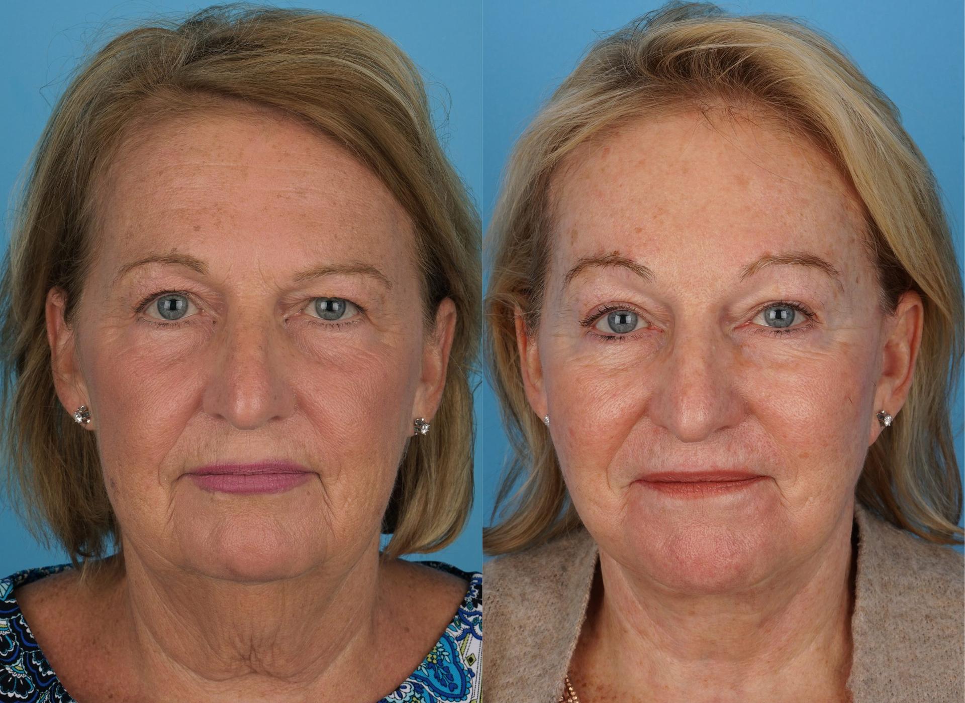 Jefferson Facial Plastics facelift result — Philadelphia, PA