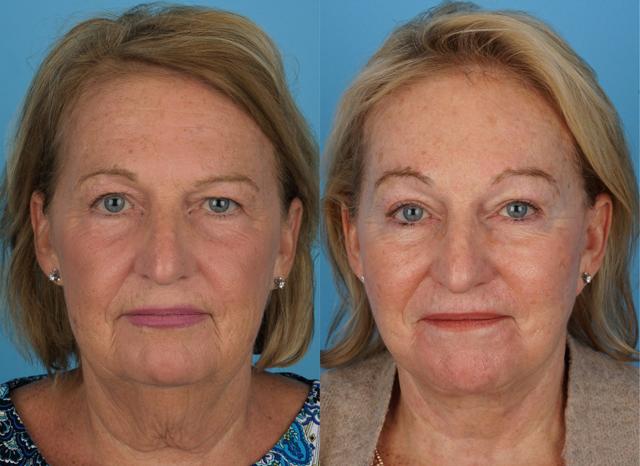 Facelift result at Jefferson Facial Plastics in Philadelphia, PA