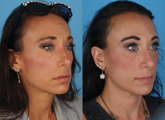 Rhinoplasty result at Jefferson Facial Plastics in Philadelphia, PA