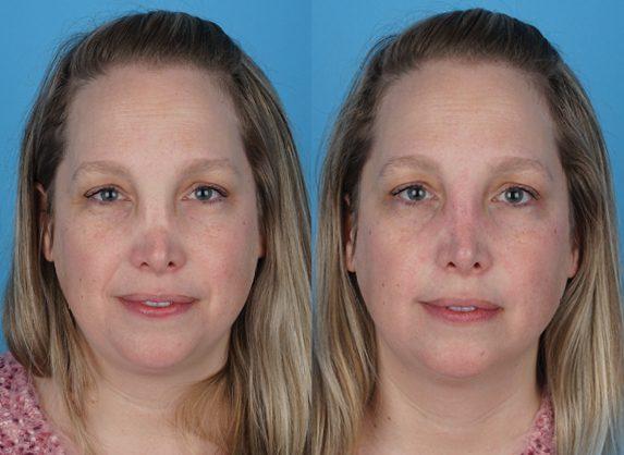 Functional Rhinoplasty result at Jefferson Facial Plastics in Philadelphia, PA