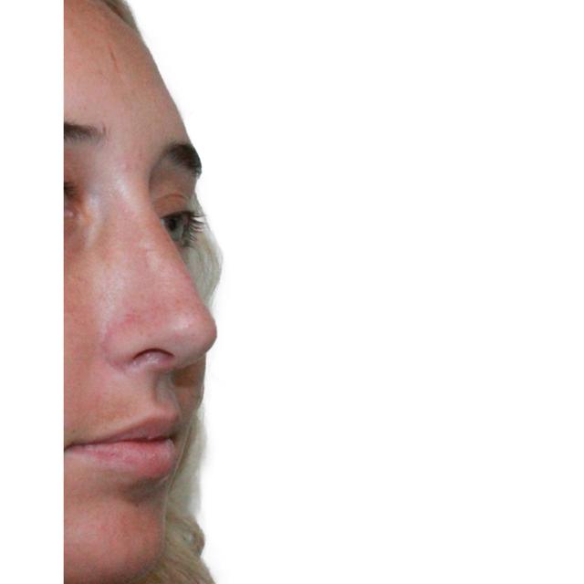 Functional Rhinoplasty after at Dr. Nataliya Biskup in Wichita, KS