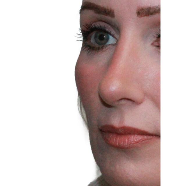 Functional Rhinoplasty after at Dr. Nataliya Biskup in Wichita, KS