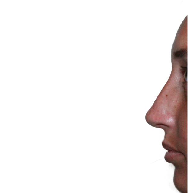 Functional Rhinoplasty after at Dr. Nataliya Biskup in Wichita, KS