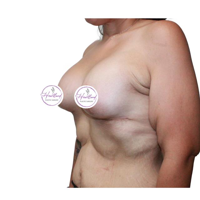 Breast Lift after at Dr. Nataliya Biskup in Wichita, KS