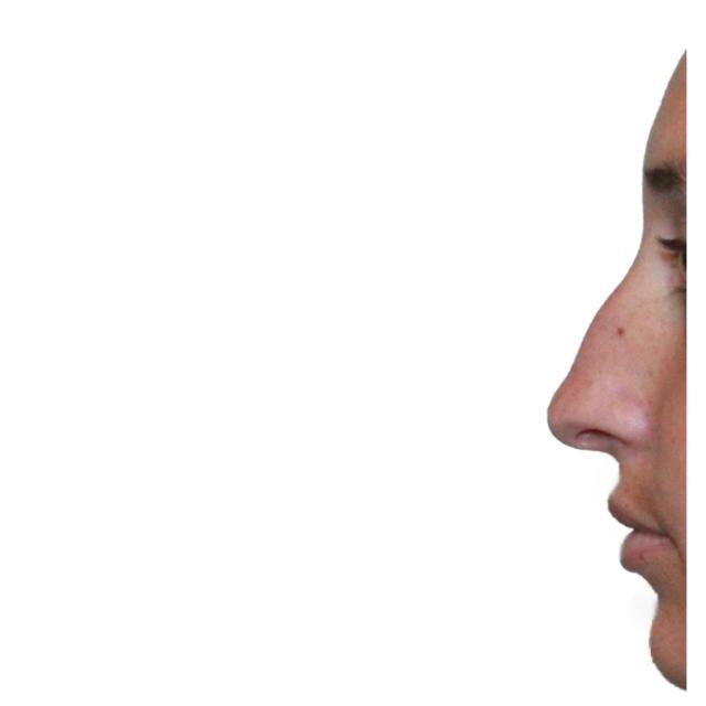 Functional Rhinoplasty before at Dr. Nataliya Biskup in Wichita, KS