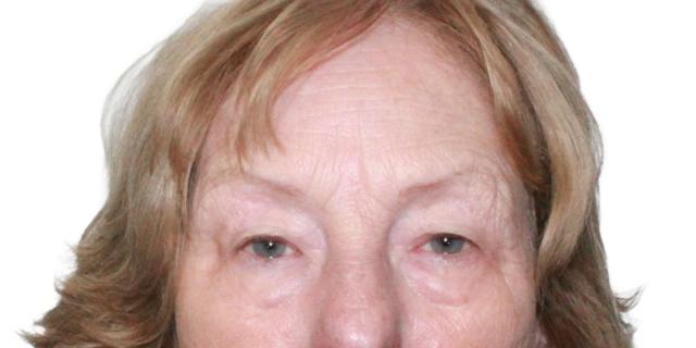 Blepharoplasty before at Dr. Nataliya Biskup in Wichita, KS