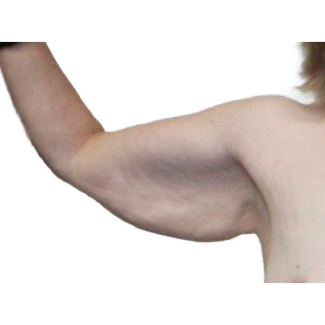 Arm Lift before at Dr. Nataliya Biskup in Wichita, KS