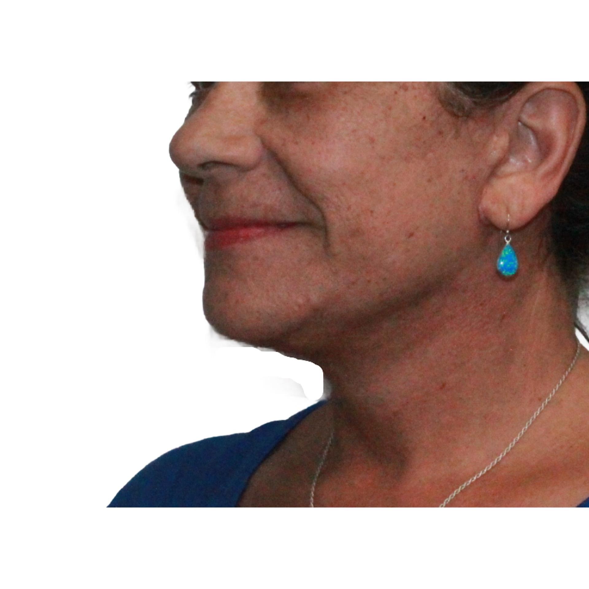 Dr. Nataliya Biskup facelift after — Wichita, KS