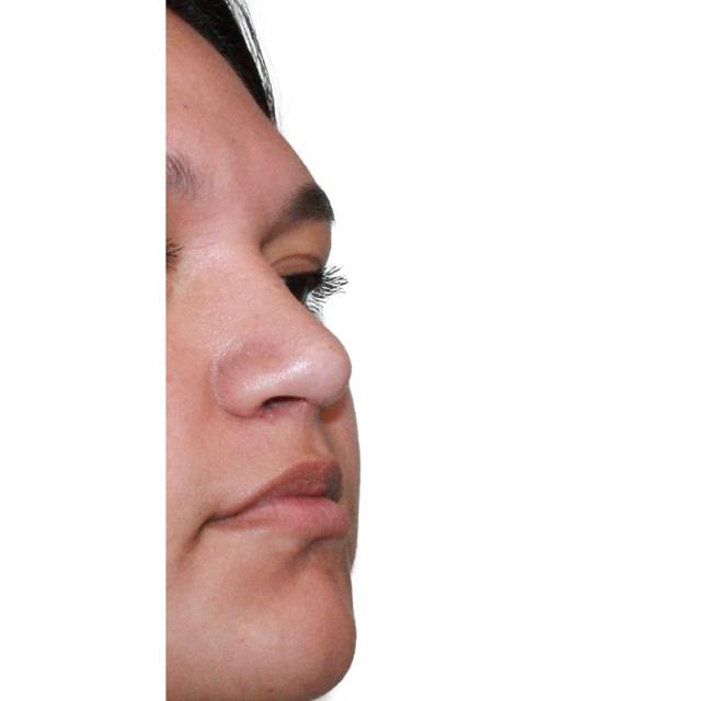 Functional Rhinoplasty after at Dr. Nataliya Biskup in Wichita, KS