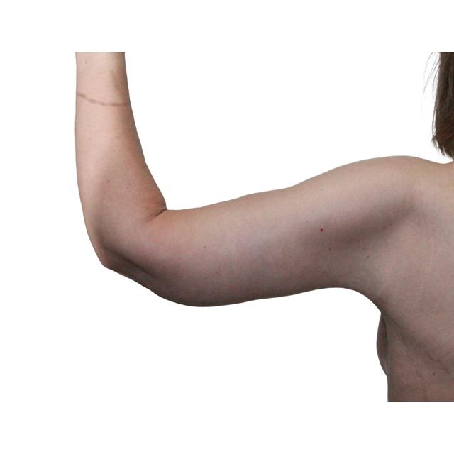Arm Lift after at Dr. Nataliya Biskup in Wichita, KS