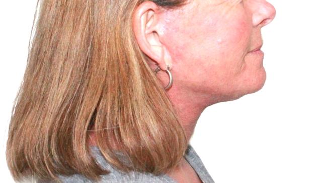Neck Lift after at Dr. Nataliya Biskup in Wichita, KS