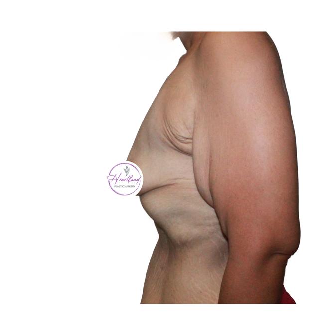 Breast Lift before at Dr. Nataliya Biskup in Wichita, KS
