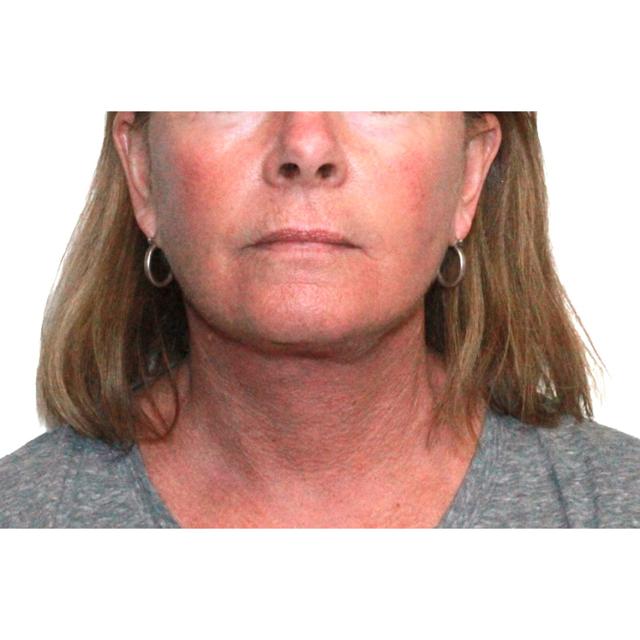 Neck Lift after at Dr. Nataliya Biskup in Wichita, KS