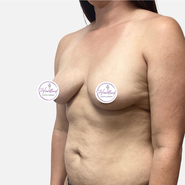 Fat Transfer Breast Augmentation before at Dr. Nataliya Biskup in Wichita, KS