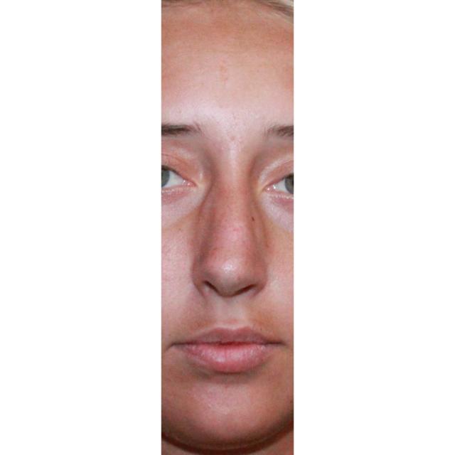 Functional Rhinoplasty after at Dr. Nataliya Biskup in Wichita, KS
