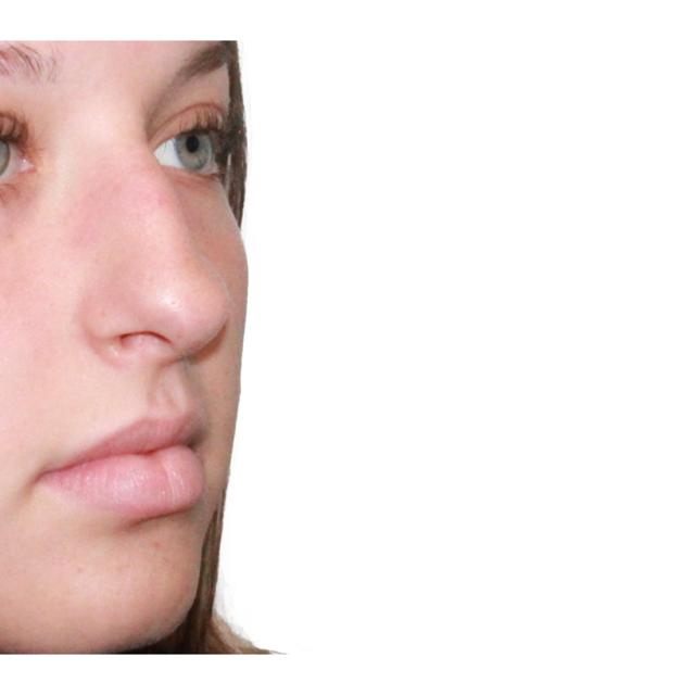Functional Rhinoplasty before at Dr. Nataliya Biskup in Wichita, KS