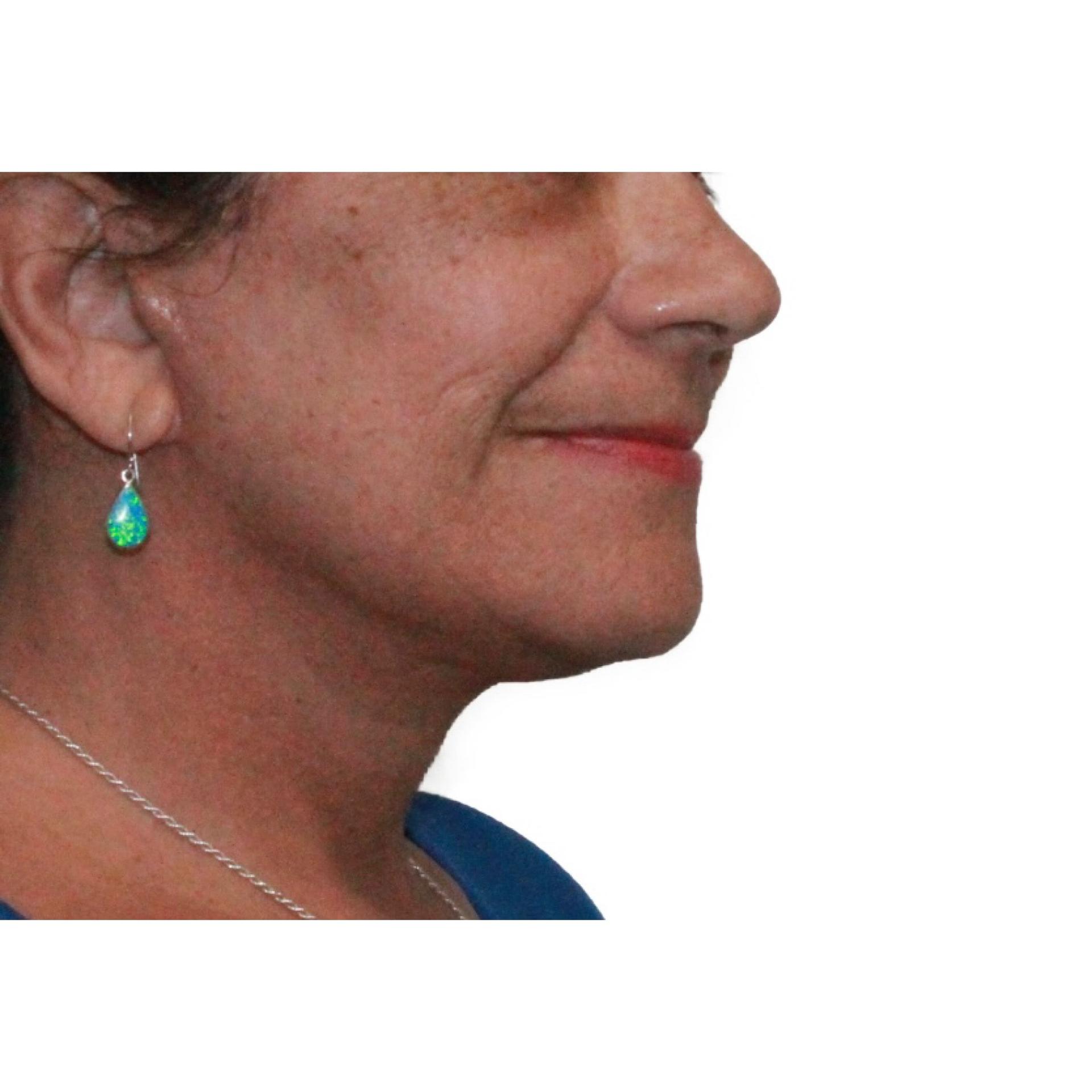 Dr. Nataliya Biskup facelift after — Wichita, KS